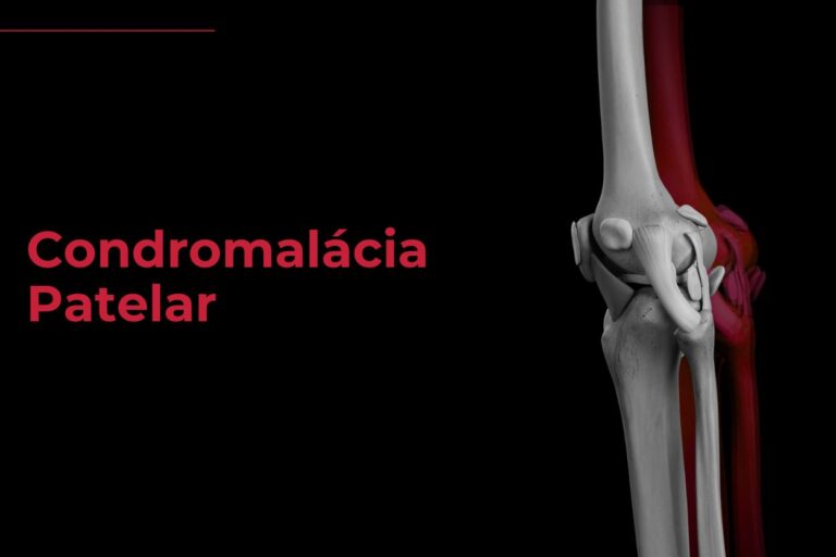 Condromalácia Patelar