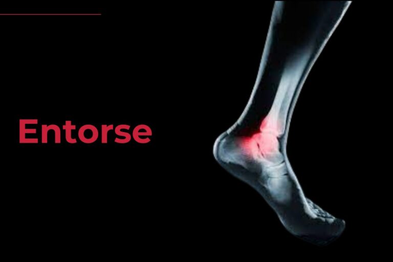 Entorse