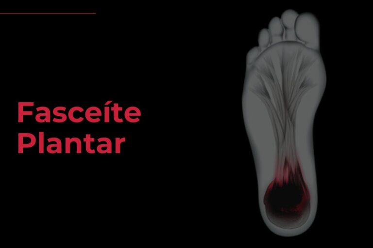 Fascite Plantar