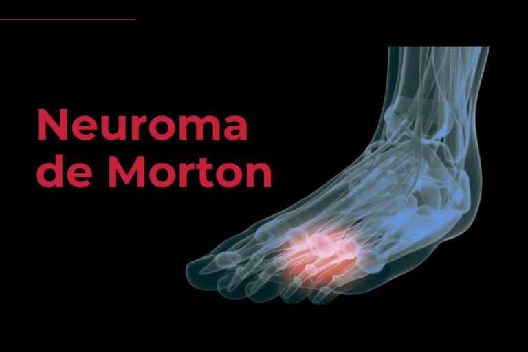 Neuroma de Morton