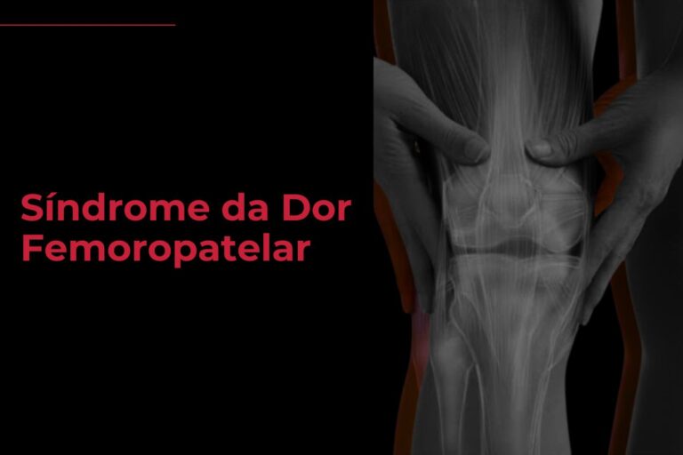 Síndrome da Dor Femoropatelar
