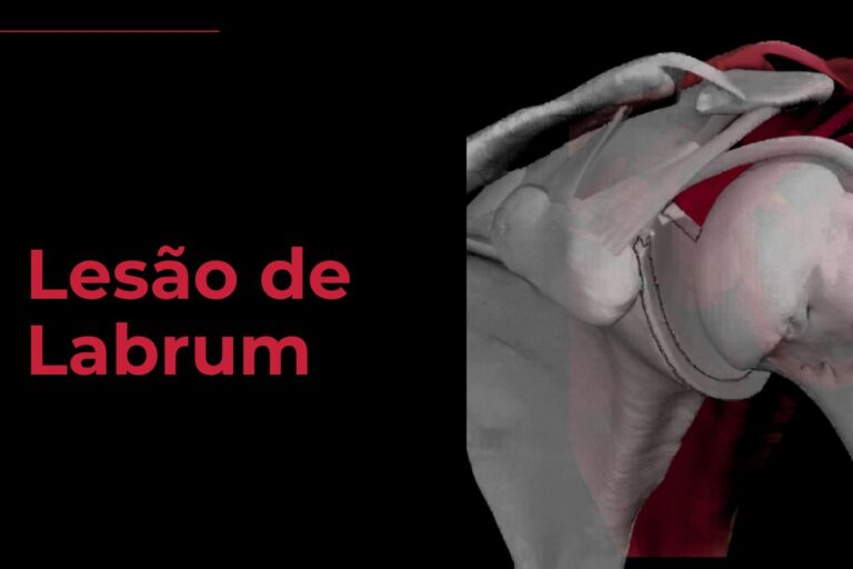 Lesão de Labrum